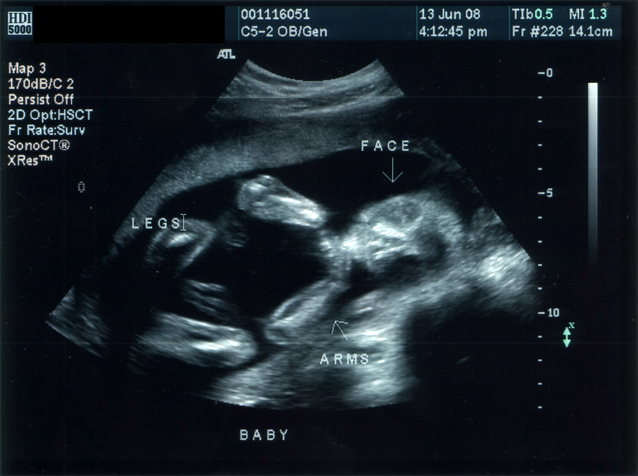 21 Weeks Pregnant Ultrasound Gender 21 Weeks Pregnant Ultrasound Gender