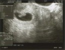 First ultrasound photo