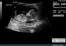 New ultrasound